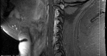 Mysterious Object (Alien implant?) Shows Up on MRI Unexpectedly