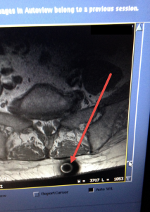 Object seen on MRI, on two different occasions. Identity is unknown.
