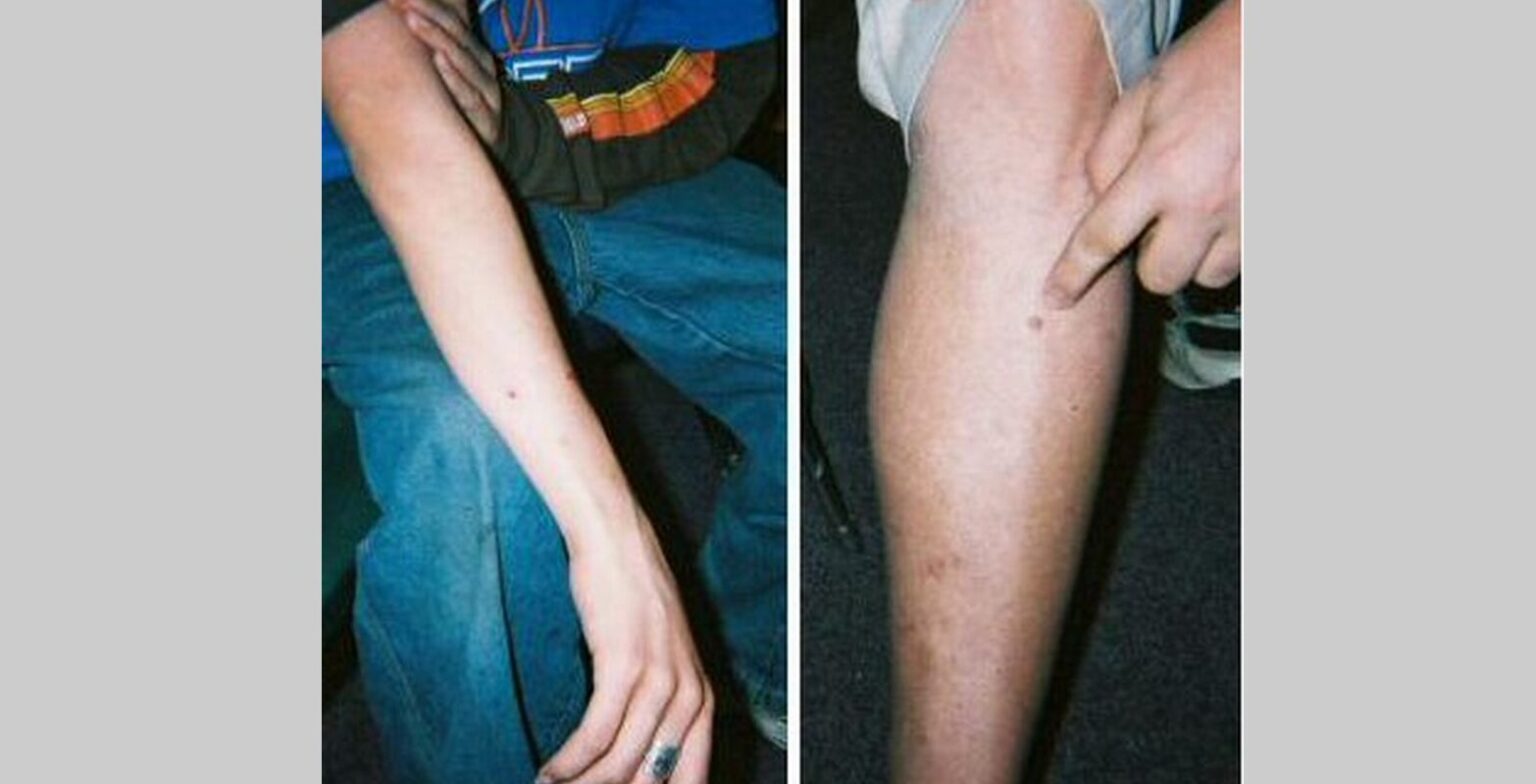 Family Bears “Scars” of Alien Abduction?