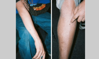 Family Bears “Scars” of Alien Abduction?