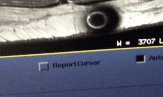 Unknown Object Appears in MRI