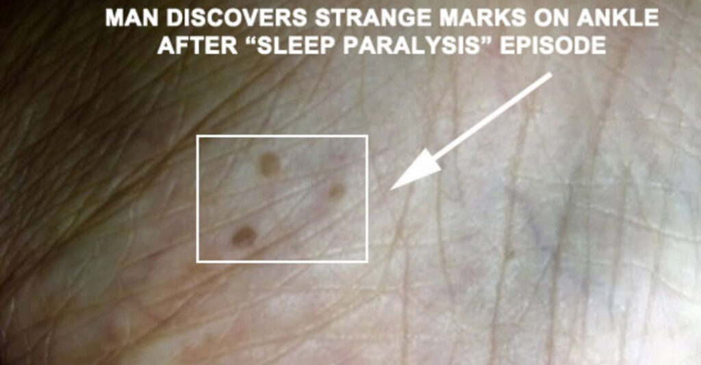 Man Finds 3 Strange Marks on Ankle After Sleep Paralysis Episode